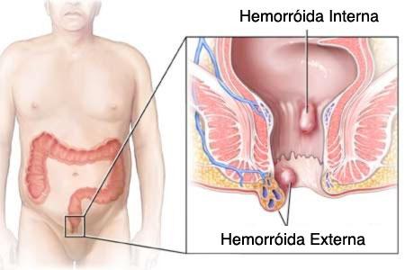 Remédios caseiros para hemorroidas Remédios caseiros para hemorroidas