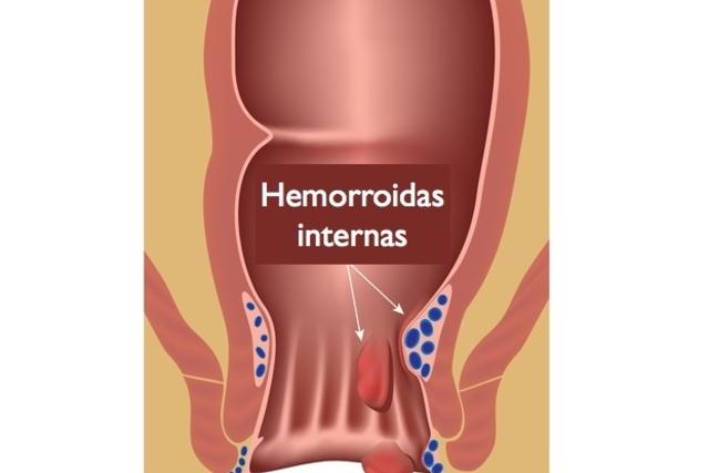 Remédios caseiros para hemorroidas Remédios caseiros para hemorroidas